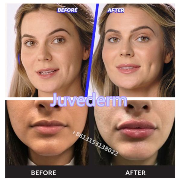 Шприц Juvederm заполнителей Voluma/ультра Juvederm дермальный с Lido
