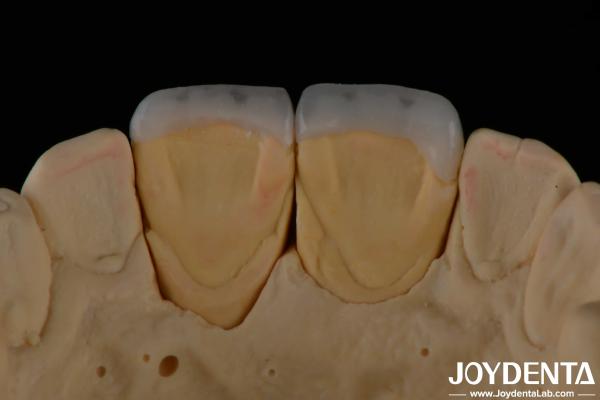 Long Lasting Dental Feldspathic Veneer Natural Tooth Color Translucent Appearance
