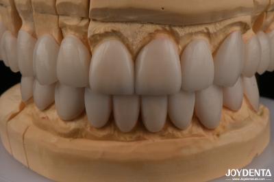0.3mm Thickness Ips Emax Veneers Ceramic Veneers Anterior Posterior Restorations