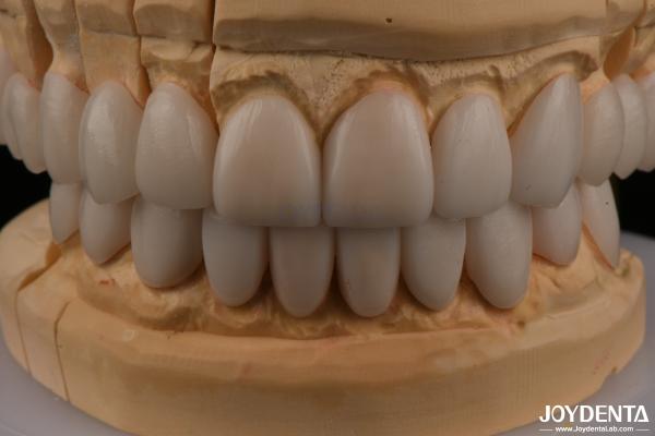 0.3mm Thickness Ips Emax Veneers Ceramic Veneers Anterior Posterior Restorations