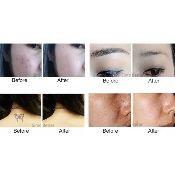 Home LCD Screen Cosmetic Devices Plasma Pen Beauty For Tattoo Removal