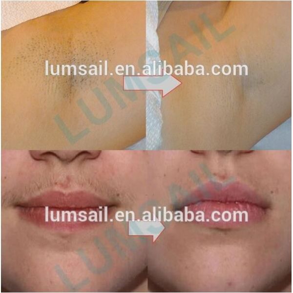 Касайтесь охлаждая машине удаления волос лазера ИПЛ/машине Реджунватион кожи безболезненным