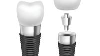 Implant dentaire Rod Comfortable Highly Biocompatible Implant de chrome de titane/cobalt