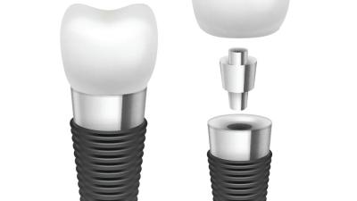 Implante dental Rod Comfortable Highly Biocompatible Implant do cromo do titânio/cobalto
