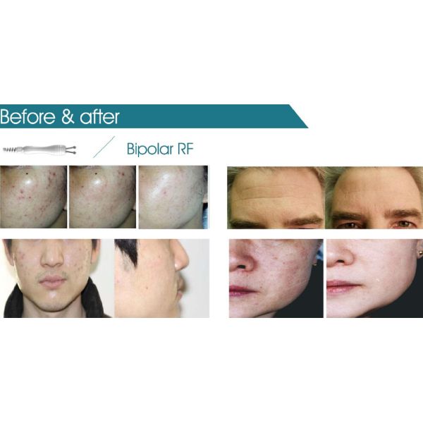 2016 best Focused ultrasound anti cellulite HIFU/ hifu/cavitation hifu