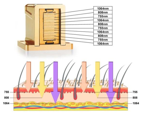 o diodo Rf da remoção do cabelo do laser de 755nm 1064nm DPL descasca o aperto do dispositivo