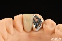 Idéal correspondant Clinical Bonding Maryland Dental Pour les travaux de réparation clinique orale