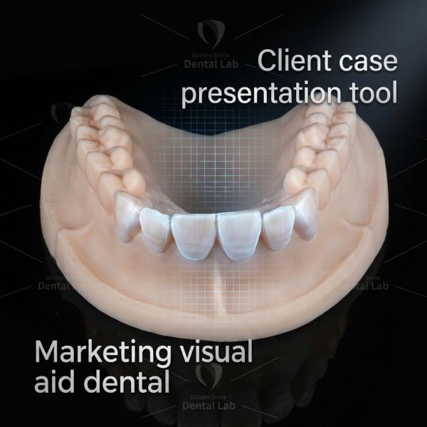 Non Prep Diagnostic Wax Up For Veneers Rehab Full Mouth Wax Up