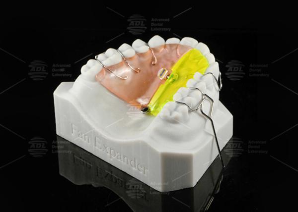 Orthodontic Fan Shaped Expander Provides Posterior Crossbite Free Section Expansion