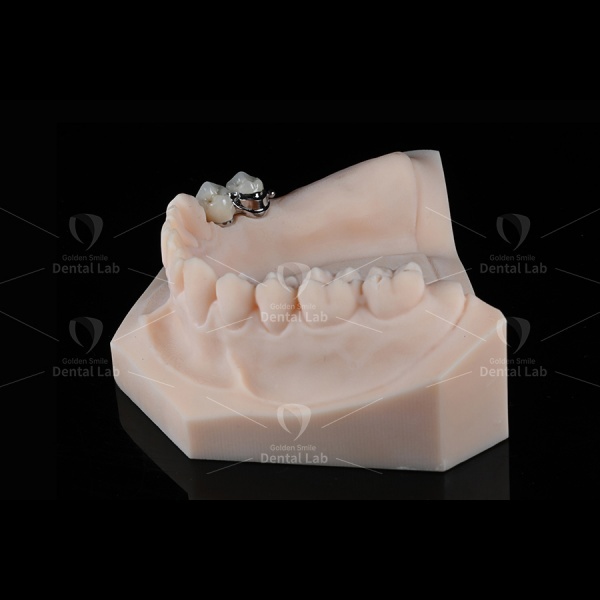 PFM Ball Abutments Dental Implants Precision Attachment Tissue Friendly