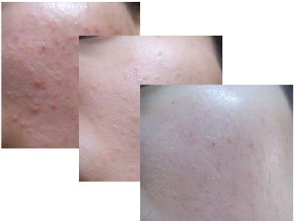 Dermabrasion машины/воды корки двигателя кислорода/гидро dermabrasion Microdermabrasion