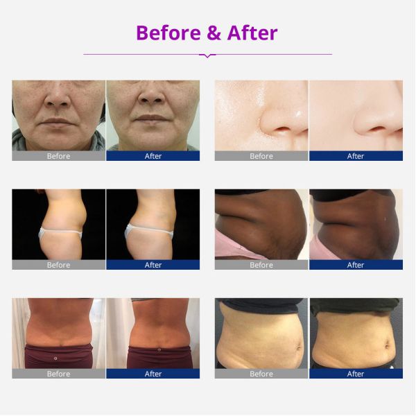 лазер 635nm 650nm Lipo уменьшая машину 40K 6 в 1 кавитации RF ультразвуковой