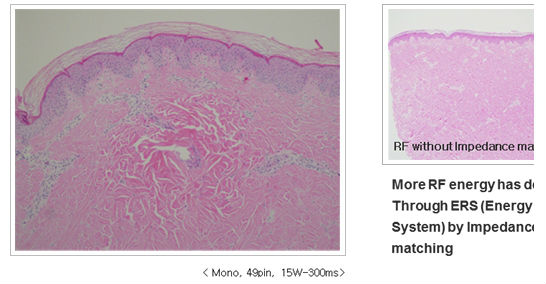 5mhz Touch High Quality Screen Thermage Skin Treatment Machine Nubway