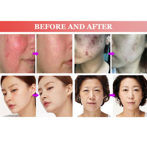 Mini Cold CE Plasma Ozone Pen Dark Circles Removal Pore Clean Skin Lifting