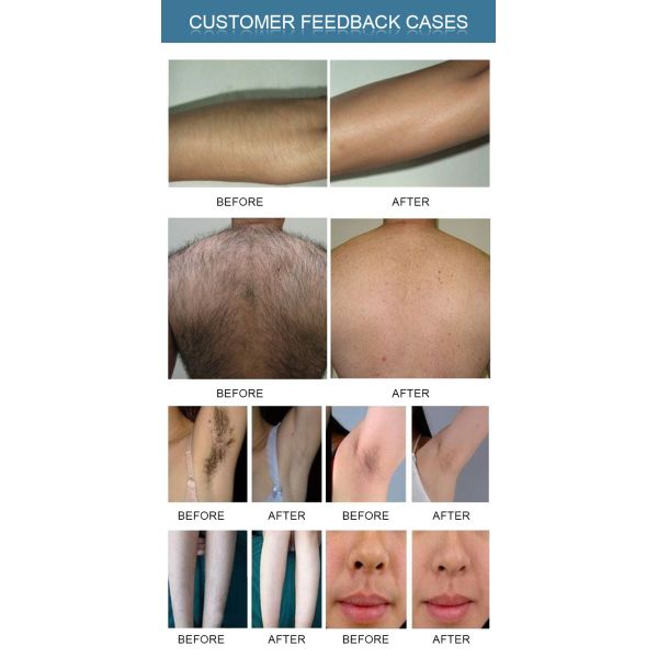 Manufacture Diode Laser Hair Removal Machine OEM Logo 810 Laser Hair Removal