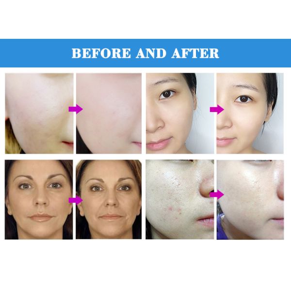 Portable Blackhead Removal and Wrinkle Removal Vacuum and Micro Crystal Dermabrasion Machine