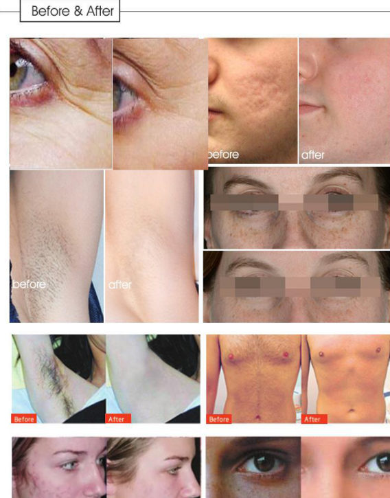 IPL SHR Permanent OPT Hair Removal Machine Skin Rejuvenation