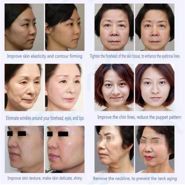 Оборудование красоты Rf для заботы кожи красоты домочадца стороны и аппаратуры красоты радиочастоты веснушки