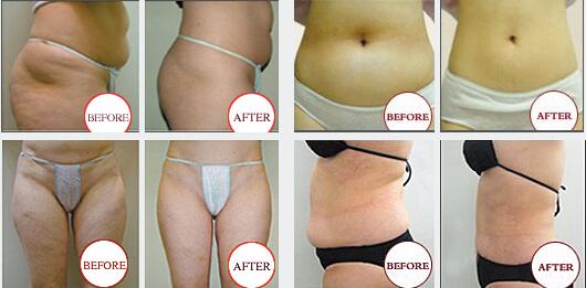 Vertical Model Body Slimming Machine 4 Handles Working Simultaneously