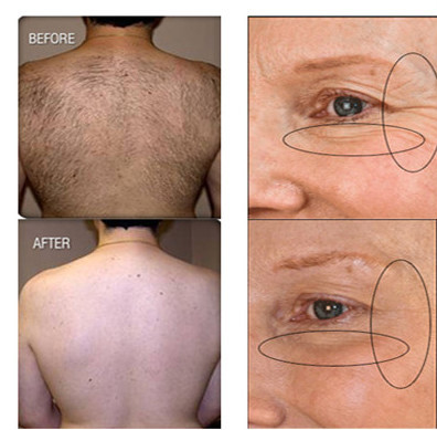 Factory Multifunctional Medical laser hair reomva SHR+OPT+Elight+ RF +Laser beauty IPL shr