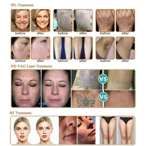 1320nm 1064nm 755nm 532nm OPT IPL Laser Hair Removal Machine