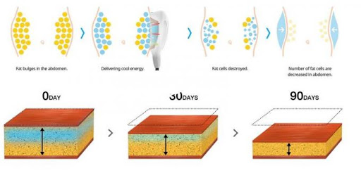 Потеря веса жирное замерзая Крйолиполысис уменьшая машину