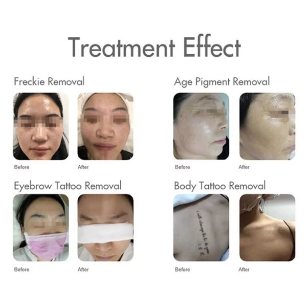 Портативный пикосекундный лазер Nd Yag с длиной волны 3 для удаления пигмента