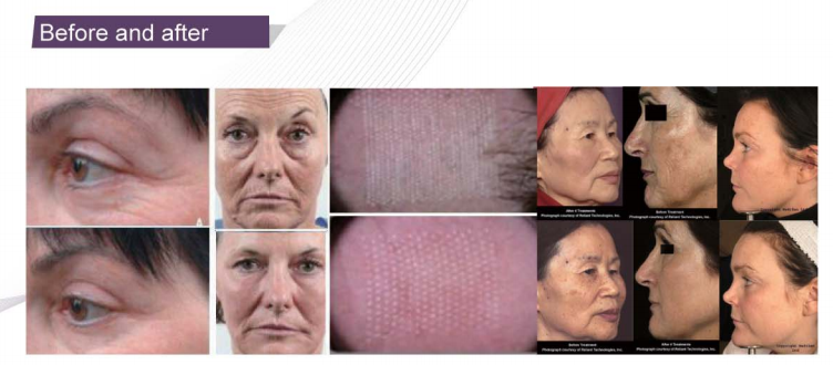 Нанесите шрам машина 30в 40в 50в лазера СО2 удаления частичная с 5 головами обработки