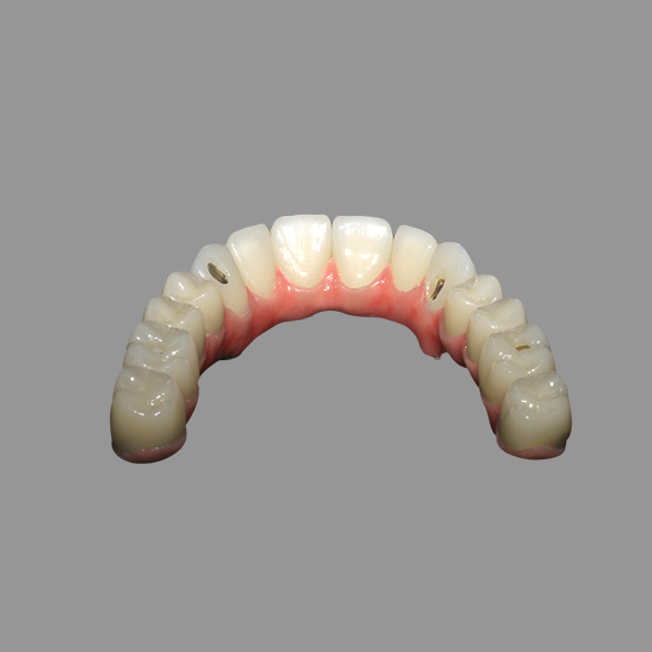 Dental Implant Lab | Class 2 Hybrid Malong Full Arch AOX Implant Bridge Titanium Bar With Full Solid Zirconia