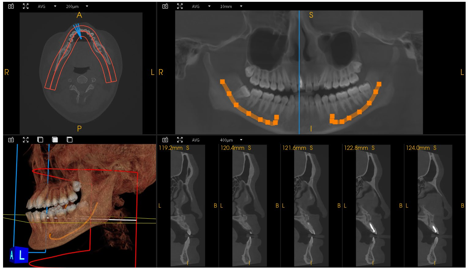 Dental Implant Orthodontic CBCT System High-Resolution 3D Imaging for Precise Diagnosis