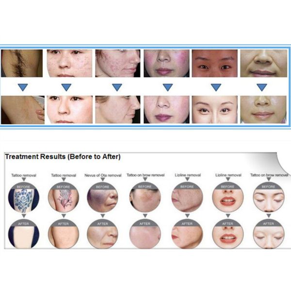 Multifunction IPL SHR Hair Removal Machine / YAG Laser tattoo removal Machine