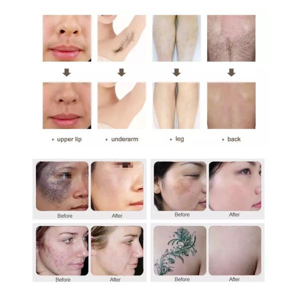 OPT Elight IPL Laser Hair Removal Machine 530nm Intense Pulsed Light Equipment