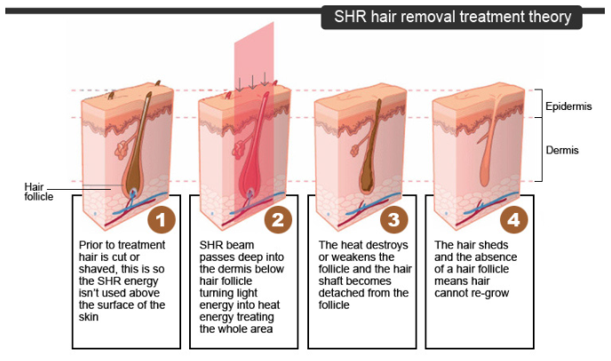 Pain Free 810nm Diode Laser Device Permanent Hair Removal Equipment