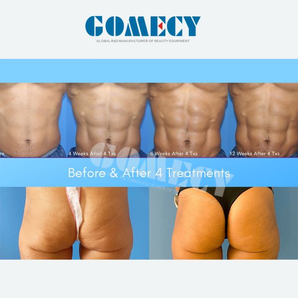 Горячая продажа Trusculpt изгибает тонкое тело ваяя уменьшающ гибкий трубопровод Trusculpt группы Newangi стимулятора Trusculpt Emsmuscle машины