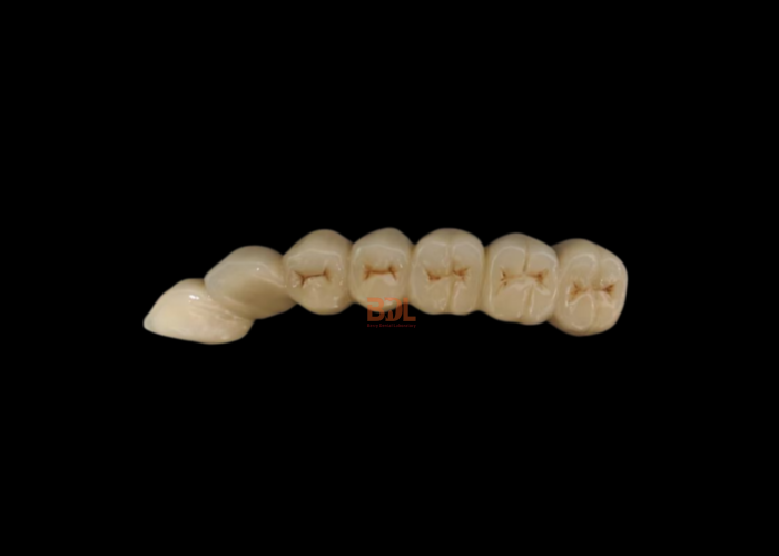 Custom Porcelain Fused To Metal Restorations Offering Superior Strength and Natural Appearance for Optimal Dental Outcomes