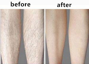 Permanent ipl laser hair removal Machine , nd yag laser tattoo removal