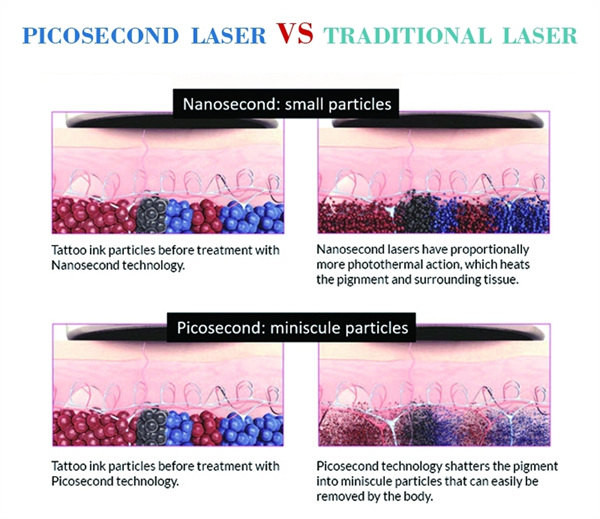 Машина 532nm 1064nm 755nm лазера пикосекунды Nd Yag