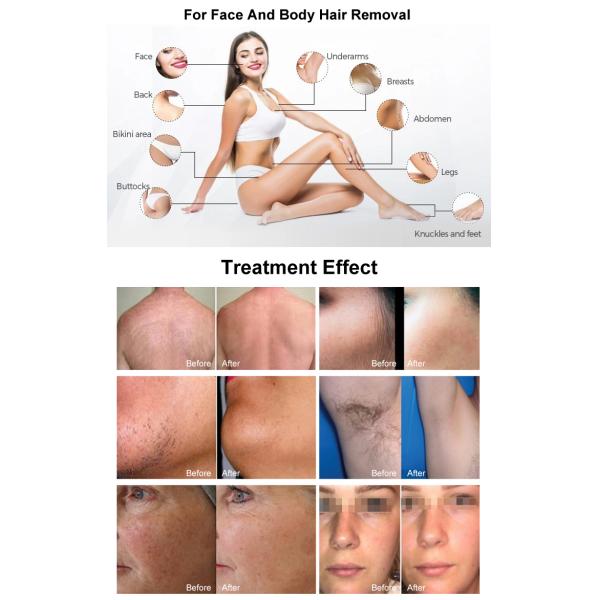 Diode Laser Hair Removal 4 Wavelength 808nm 1064nm 790nn  940nm Permanent Hair Removal By Laser Machine