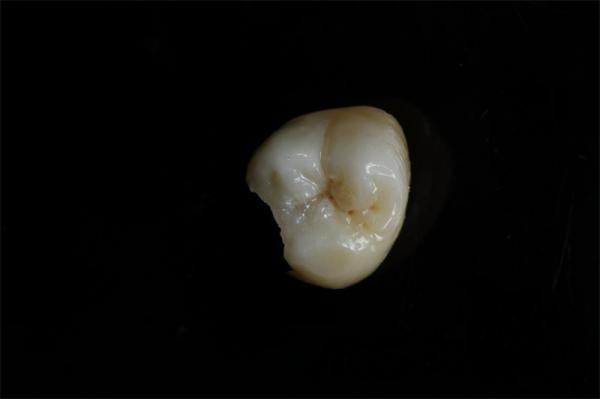 Customizable Ceramic Inlays And Onlays In Dentistry Restoration