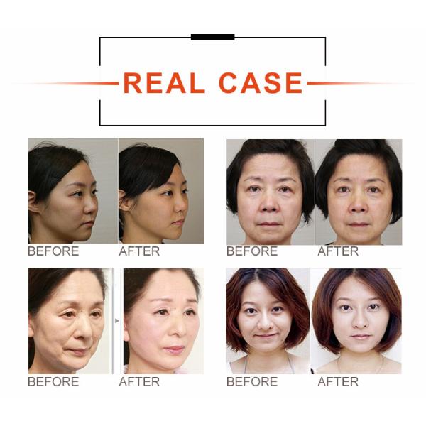Anti Aging HIFU Facial Lifting Portable Ultrasonic HIFU Beauty Machine