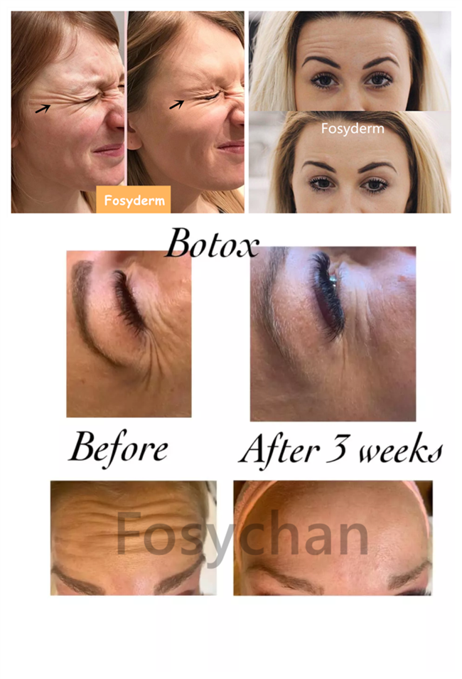 Botulinum впрыска Botox впрыски токсина для впрыски порошка удаления морщинки