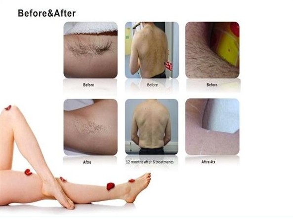 Beauty Salon machine professional diode laser hair removal machine for all skin types