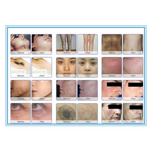 OPT SHR E- Light IPL RF Machine For Permanent Hair Removal / Acne Treatment