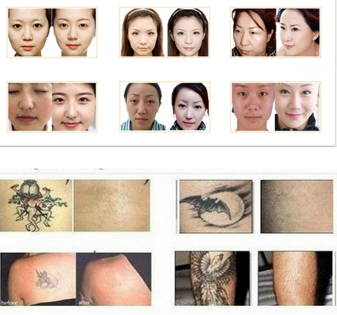 Double screens SHR hair removal machine YAG laser machine , skin rejuvenation machine