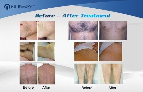 Diode laser hair removal machine / 808nm diode laser hair removal equipment