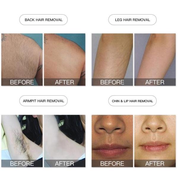 машина лазера удаления волос 1-10Хз 808нм с системой удаления волос ипл