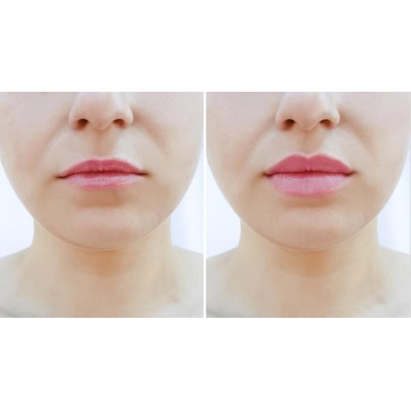 Заполнитель ультра 3 Hyaluronic кисловочный дермальный 2x1ML Juvederm для увеличения губ