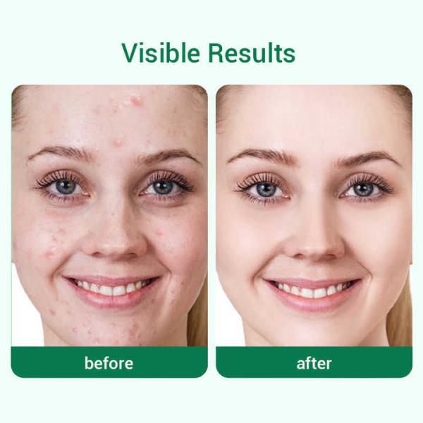 Acne Control Alpha Arbutin Nicotinamide Salicylic Acid Face Serum Multimolecular HA