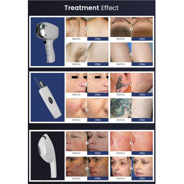 Мультифункциональная 3 в 1 808nm диодная лазерная эпиляция эпиляция татуировки