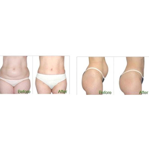 Effective Ultrasound Face Lift Machine One Handpiece Harmless To Tissue Outside